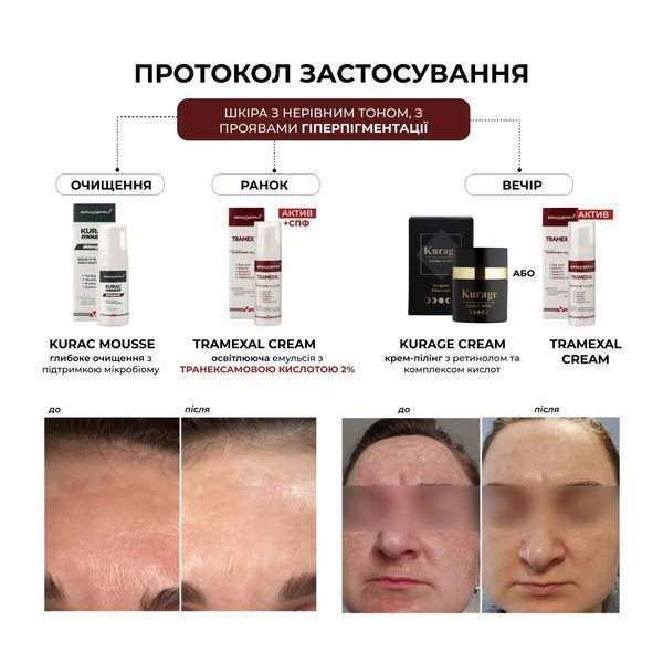 Tramexal cream Braderm &mdash; освітлювальна емульсія для шкіри 30 мл BRADERM-TRAMEXAL-30 фото