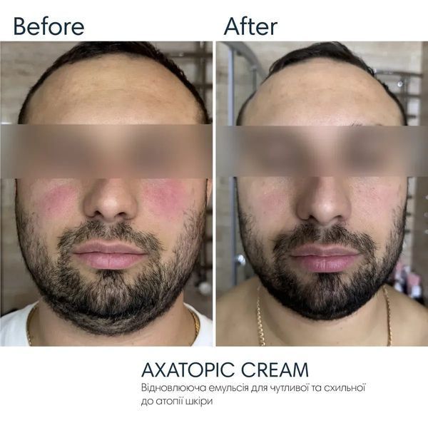 Axatopic cream Braderm &mdash; емульсія для тіла з керамідами 250 мл BRADERM-AXATOPIC-CREAM-250 фото